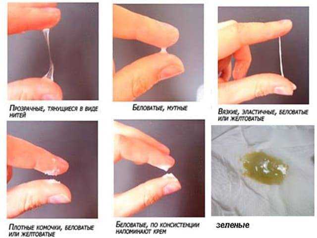 Выделения из влагалища - о каких заболеваниях это говорит
