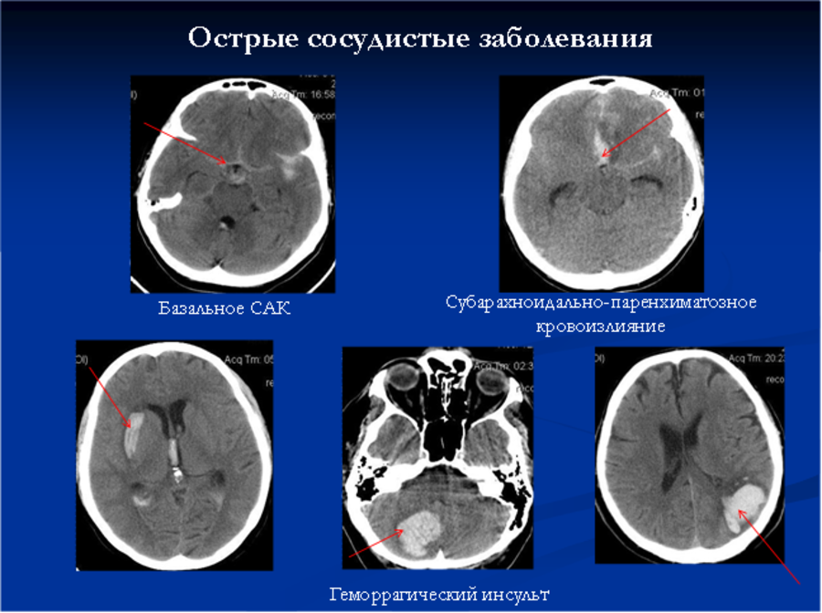 Расшифровка мрт головного. Кт головного мозга сагиттальная проекция. Кт головного мозга норма и патология. Компьютерная томография головного мозга норма. Сосудистые аномалии головного мозга мрт.