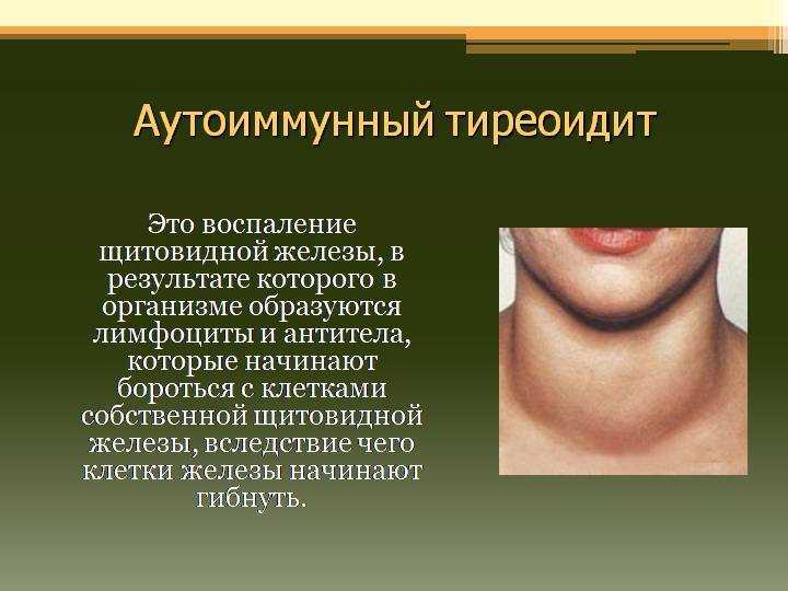 Хашимото - болезнь, разрушающая щитовидную железу * клиника диана в санкт-петербурге