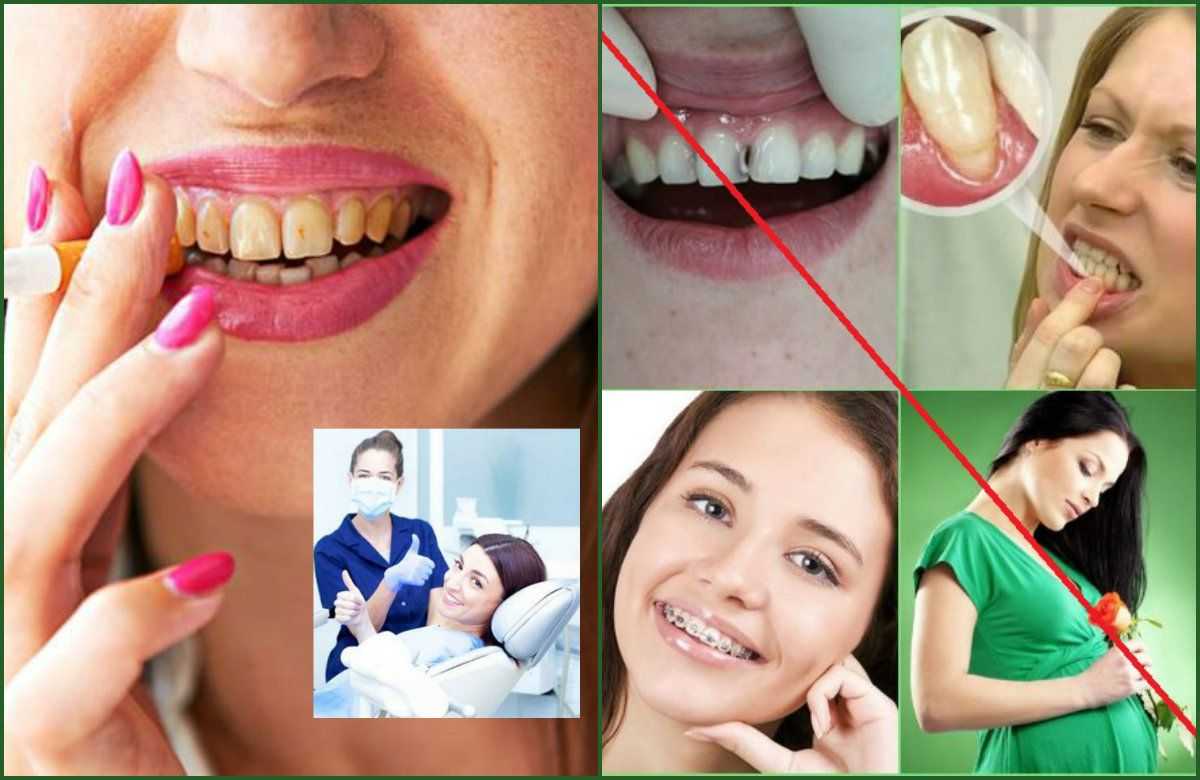 Подготовка зубов к отбеливанию