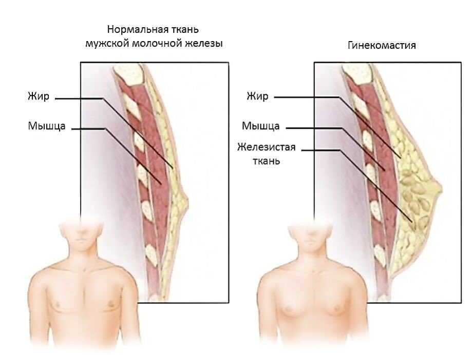 Гинекомастия - устранение увеличенных молочных желез у мужчин