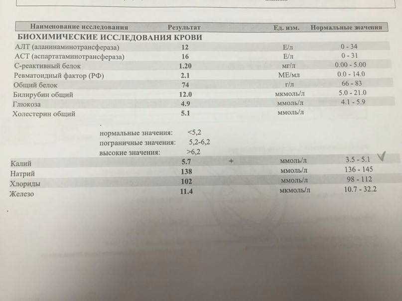 Мочевина в моче