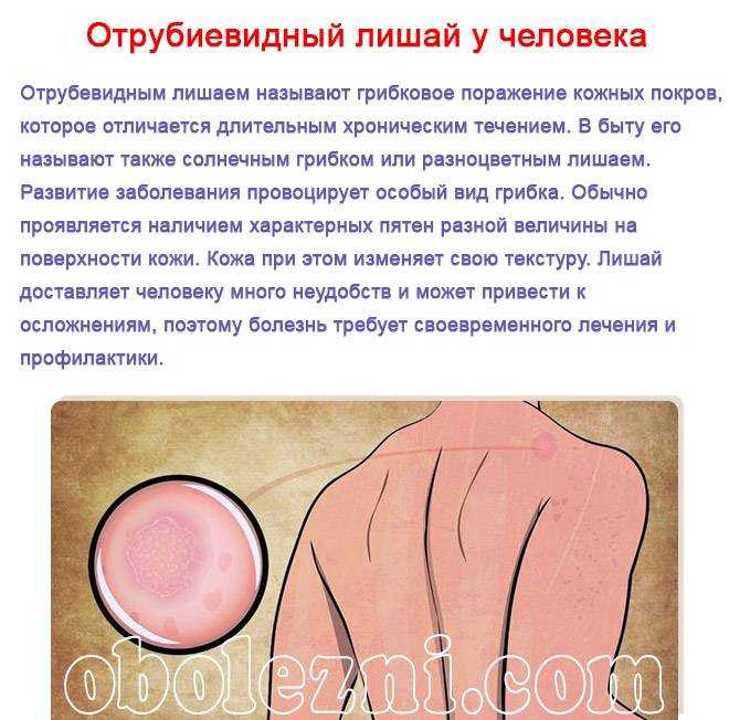 Розовый лишай