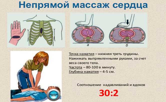 Особенности проведения прямого массажа сердца