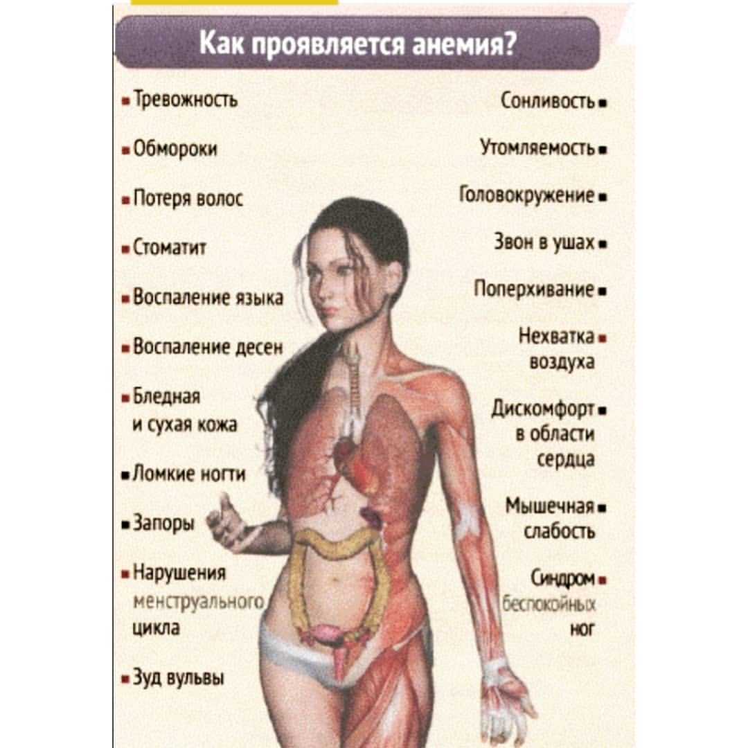 Железодефицитная анемия, симптомы и лечение