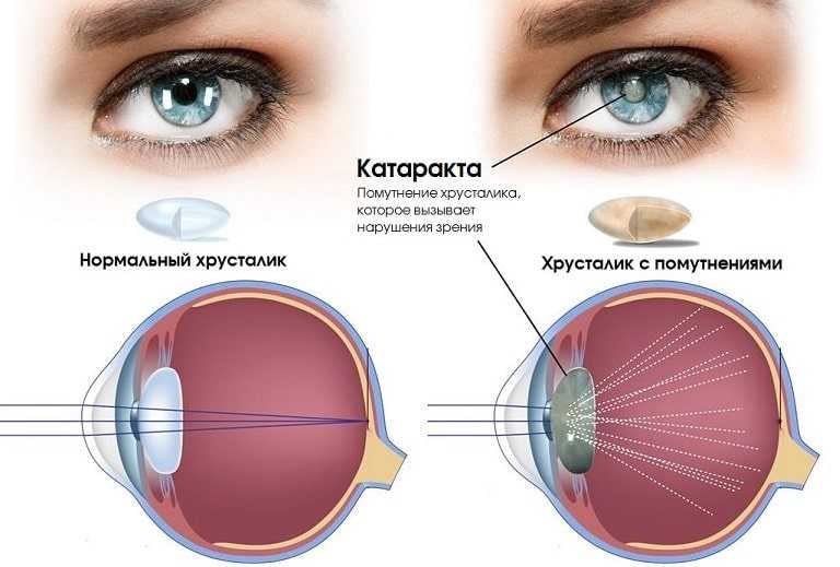 Нарушение периферического зрения