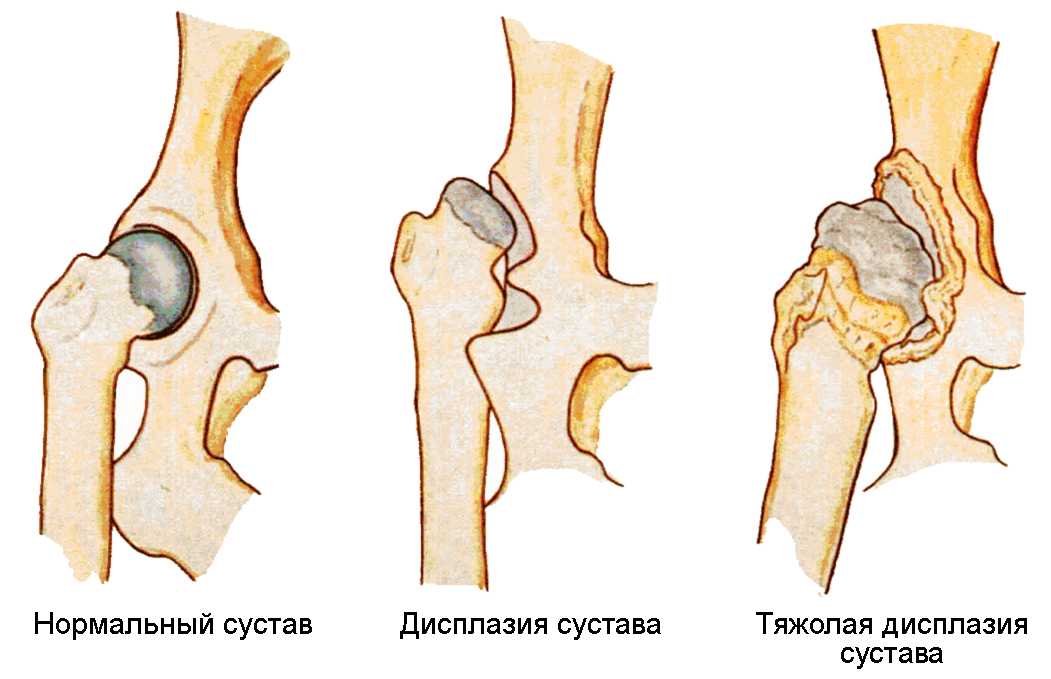 Дисплазия тазобедренного сустава у детей и новорожденных, причины возникновения, симптомы и лечение