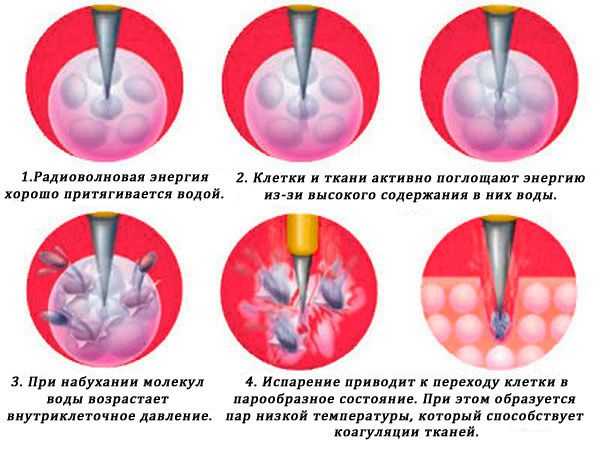 Радиоволновая конизация шейки матки