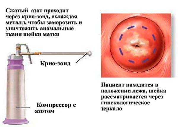 Полип в матке