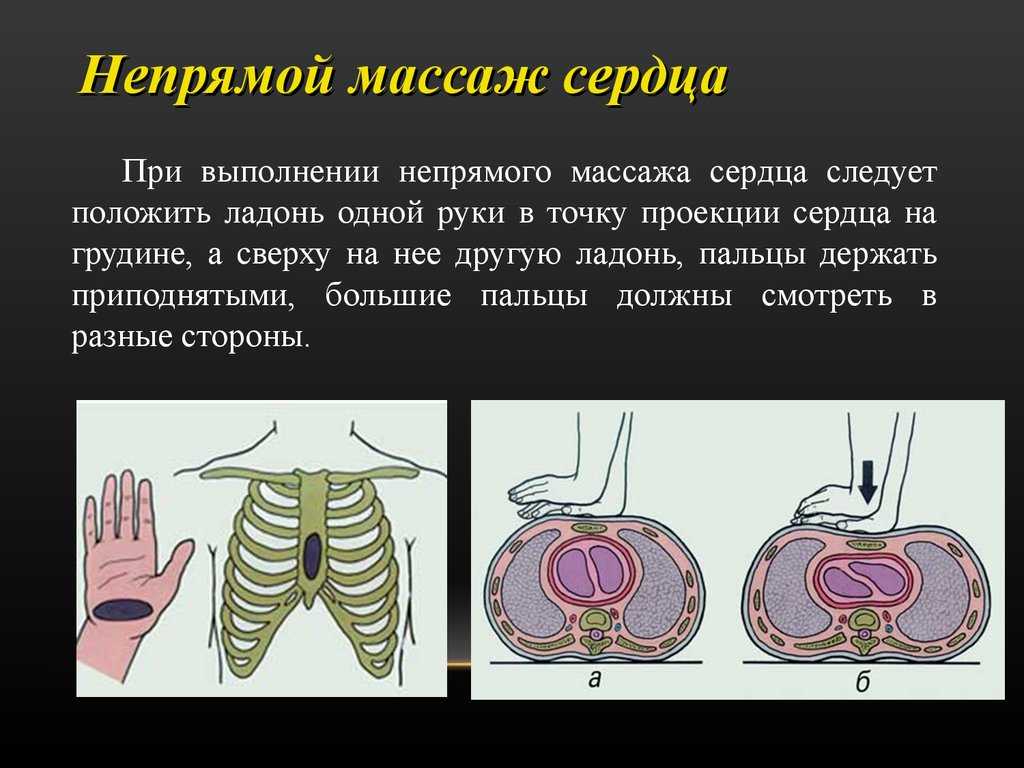 Массаж сердца. Пе прямой массаж сердца. Не примой масаж сердце. Непрямойтмассаж сердца. Непрямой массаж сердца выполняется.