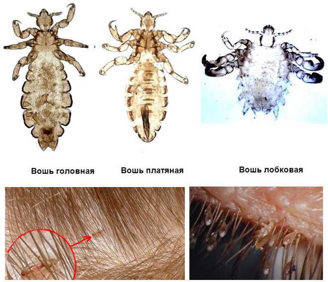 Педикулёз тела