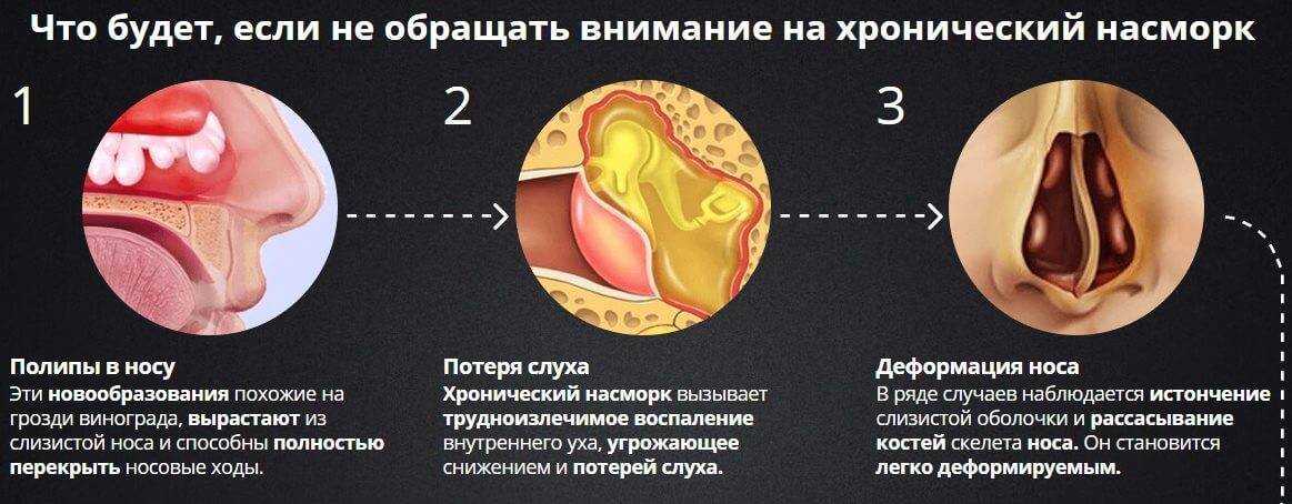 Хронический ринит: лечение и симптомы - как вылечить хронический насморк