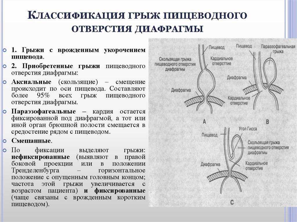 Грыжа пищевода. причины, симптомы, диагностика