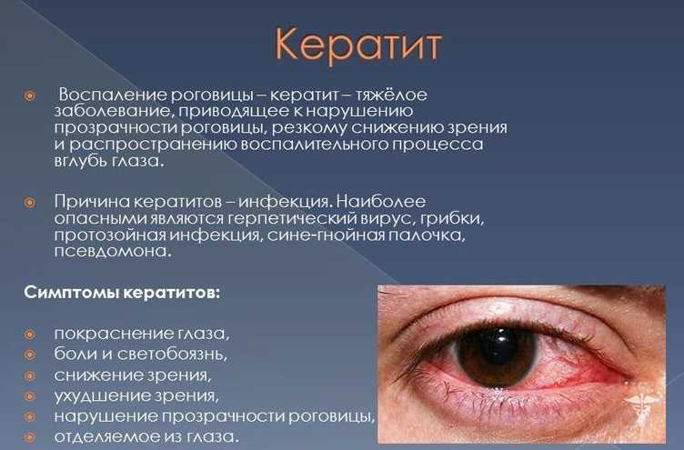 Заболевания роговицы глаза:  разновидности, симптомы, лечение
