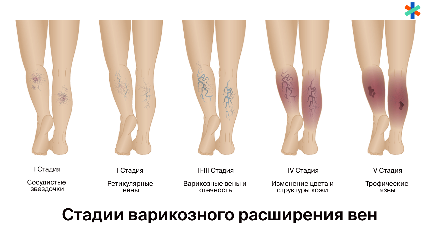 Варикоз вен на ногах – симптомы, признаки, лечение, что можно и что нельзя при варикозе