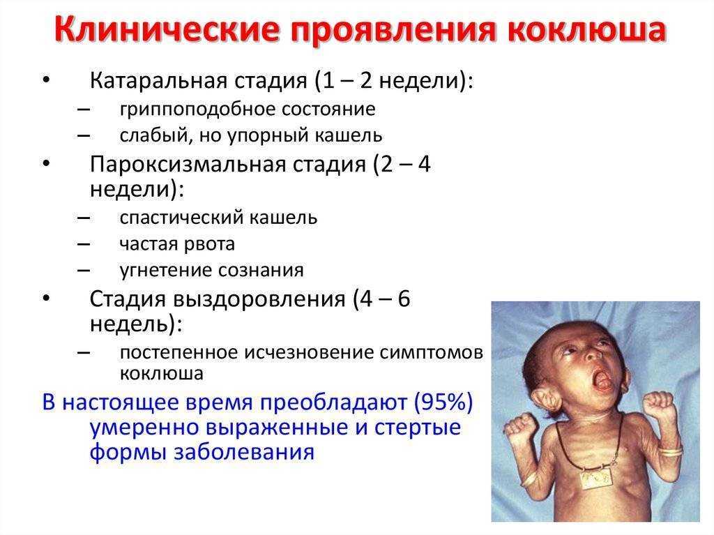 Коклюш. паракоклюш. признаки и лечение