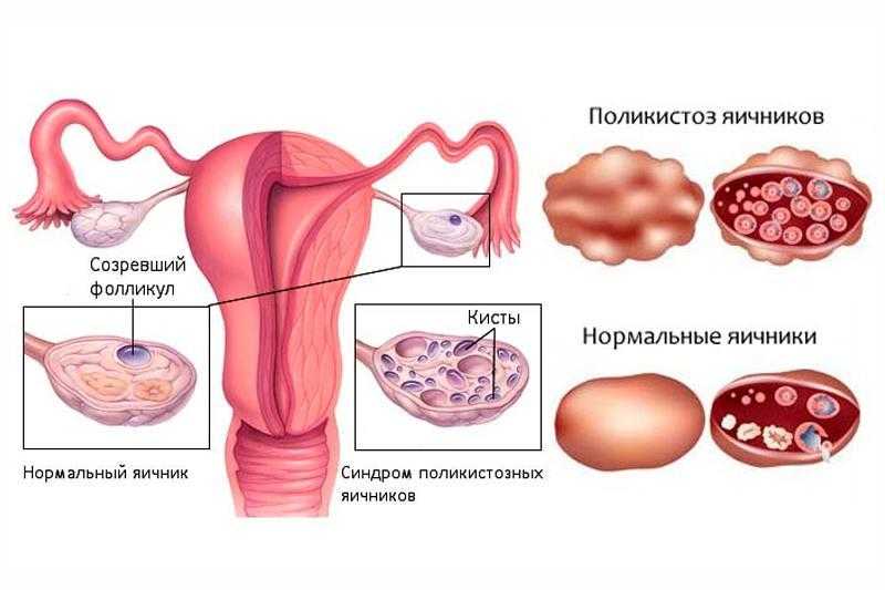Поликистоз яичников: причины, диагностика, лечение * клиника диана в санкт-петербурге
