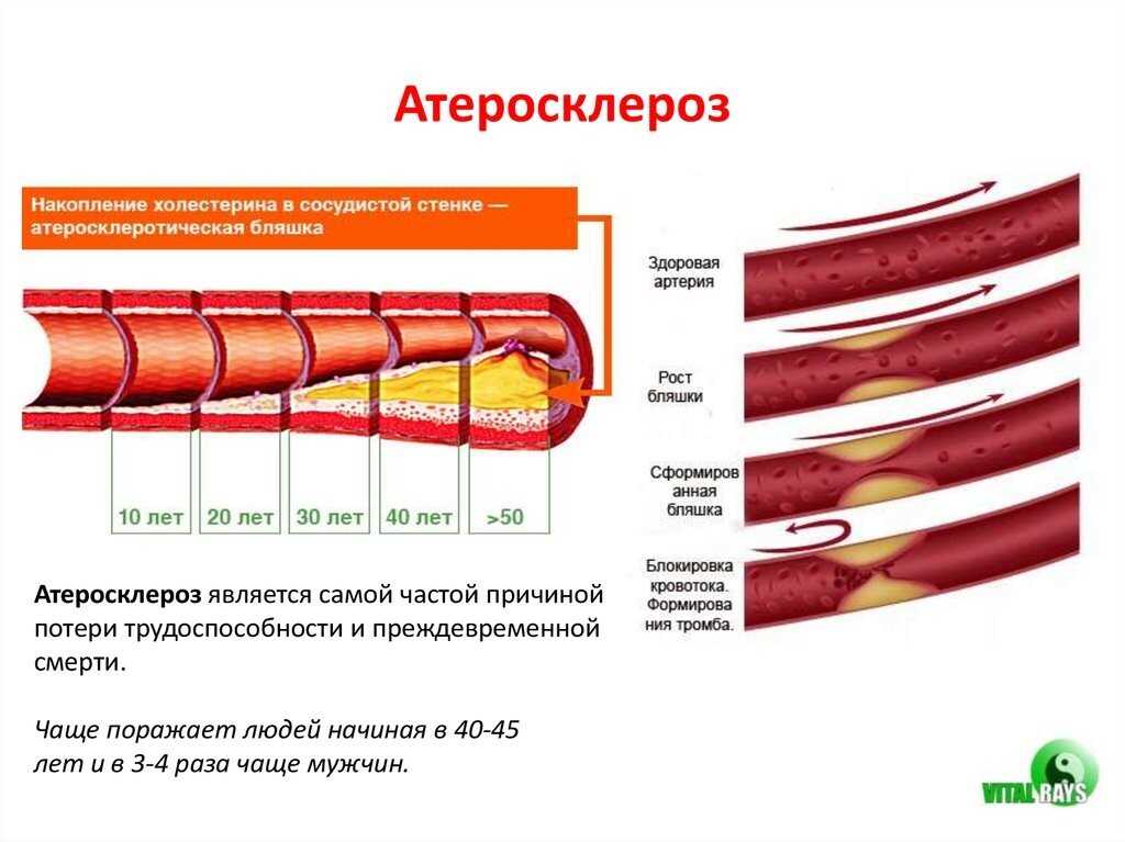 Атеросклероз: симптомы и лечение – напоправку – напоправку