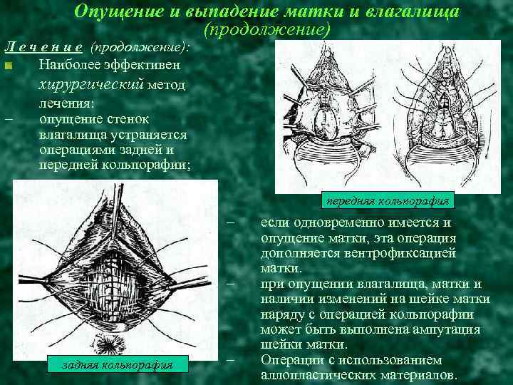 Опасные заблуждения и мифы, касающиеся опущения тазовых органов