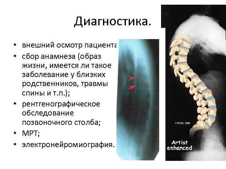 Что такое шейный кифоз? | сеть клиник «здравствуй!»