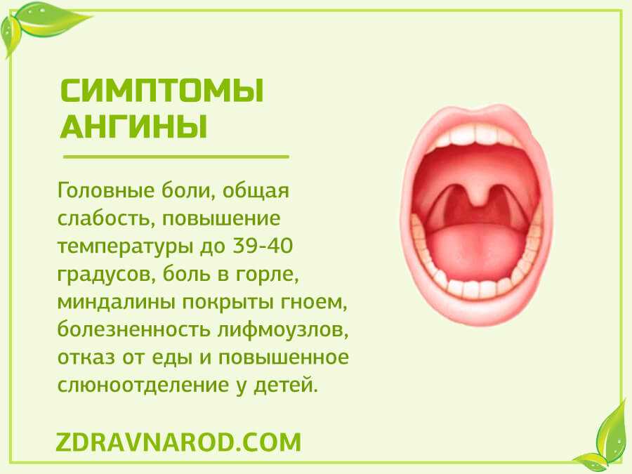 Герпетическая ангина: причины появления, симптомы, диагностика, лечение | лор кабинет