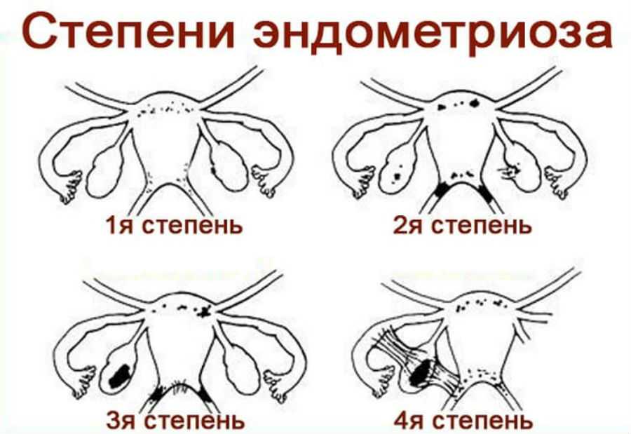 Эндометриоз