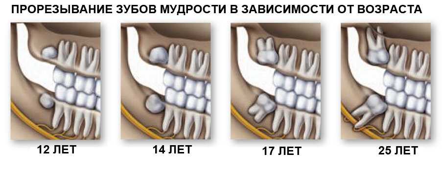 Что делать, если не вылез ни один зуб мудрости?