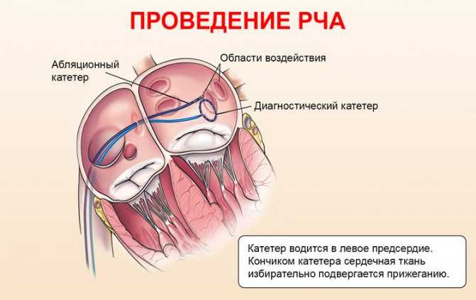 Замена сердечного клапана. показания и этапы операции