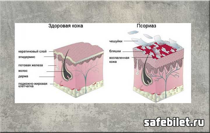 Псориаз: причины возникновения и лечение заболевания