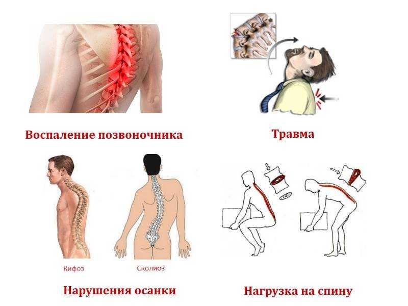 Воспаление позвоночника. Гемангиома позвоночника грудного отдела. Гемангиолипома позвоночника грудного отдела. Гемангиолипома позвоночника шейного отдела что это. Гемангиолипома позвоночника поясничного отдела.