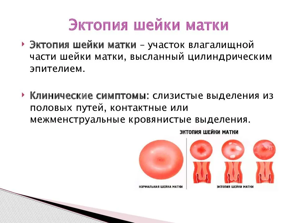 Эрозия шейки матки: симптомы, лечение и причины появления