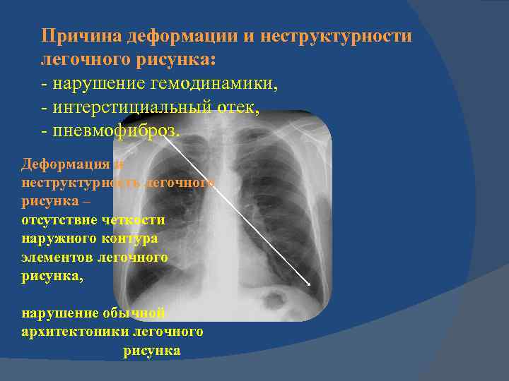 Деформация и усиление легочного рисунка на рентгене (флюорографии): что это