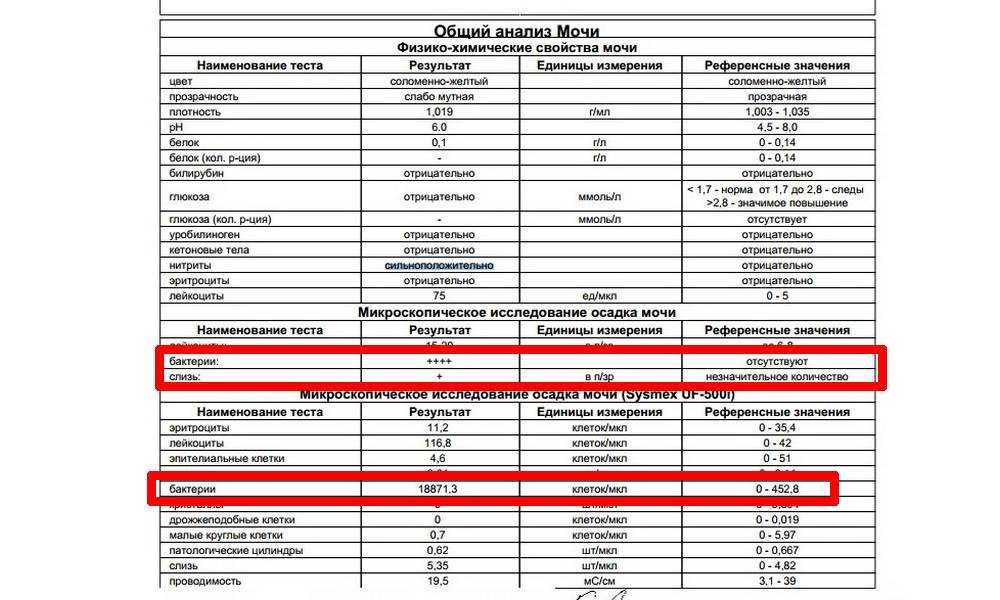 Общий анализ мочи с микроскопией осадка