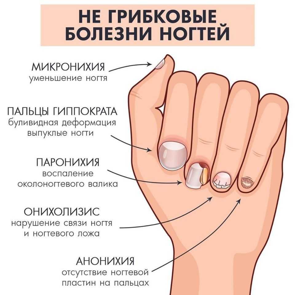Как скрыть отсутствие ногтя