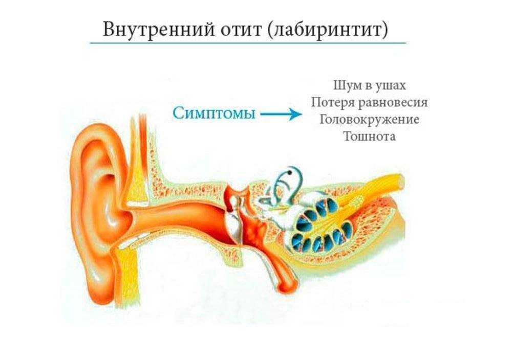 Боль в ухе (оталгия) – причины, диагностика, лечение | университетская клиника