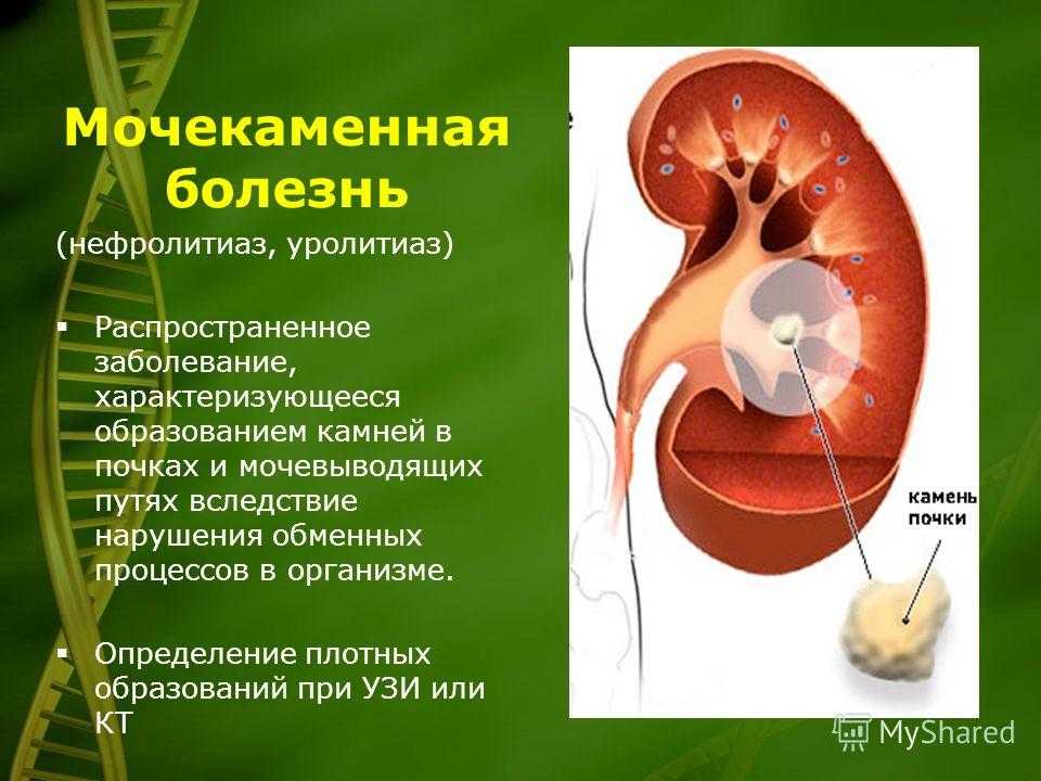 Камни в почках. причины, диагностика и лечение мочекаменной болезни.!