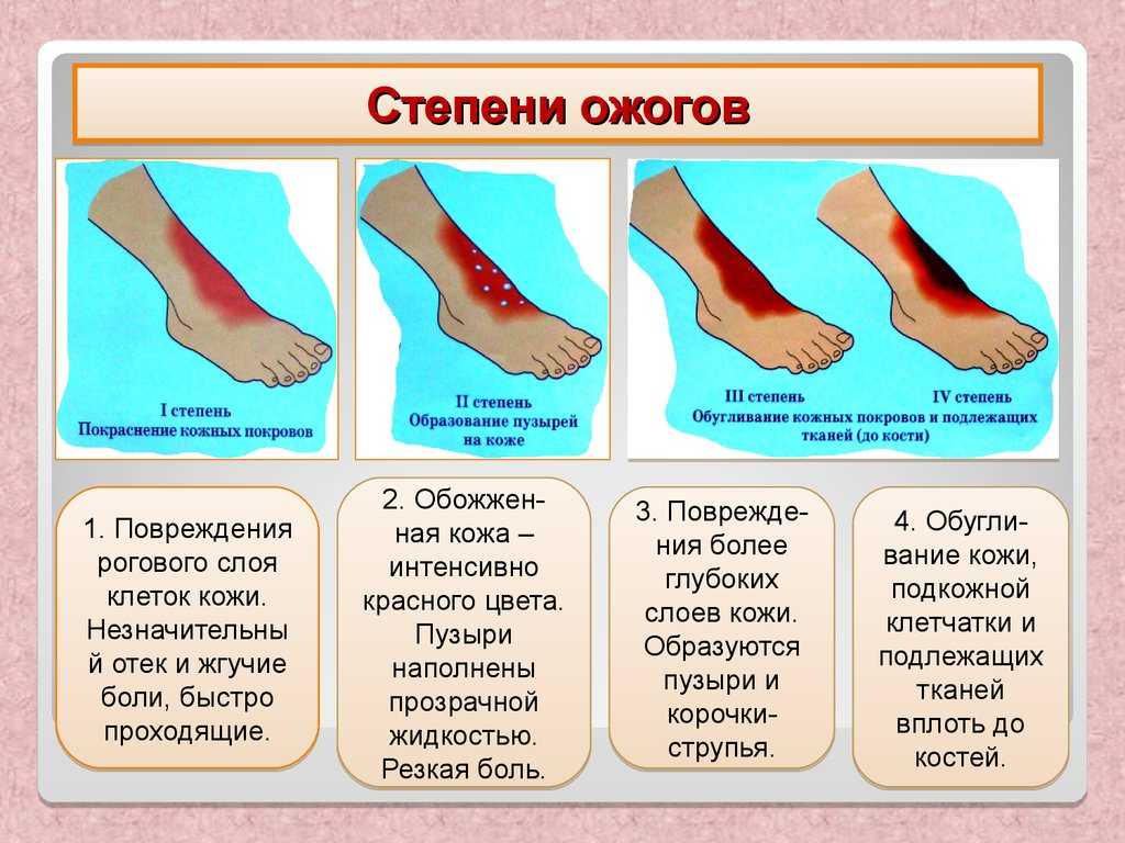 Как лечить ожог кожи | чем лечить сильные ожоги на лице, руке у ребенка