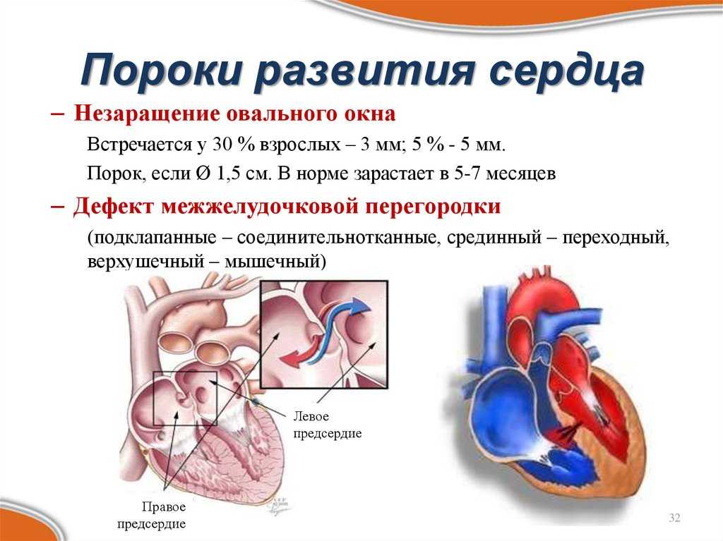 Врожденные пороки сердца у детей