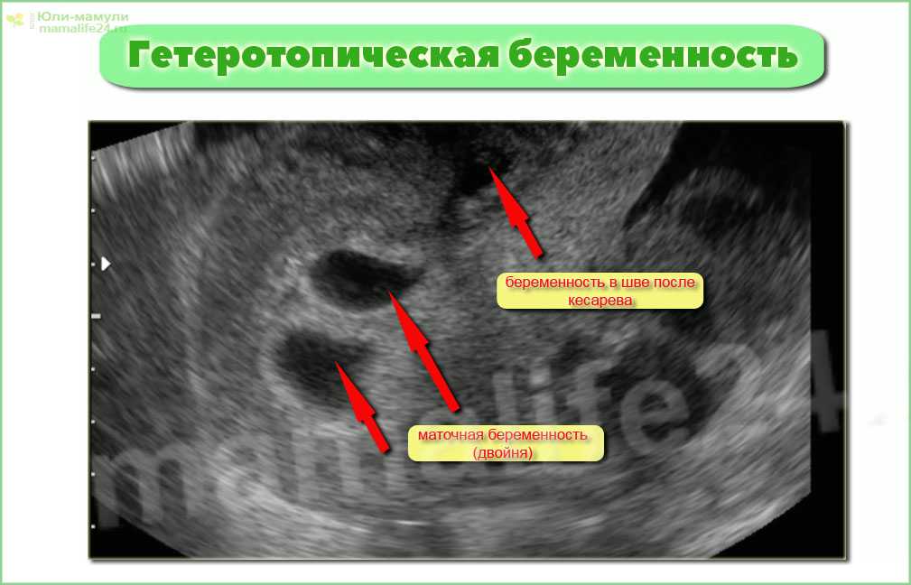 Внематочная (эктопическая) беременность: что это и как быть