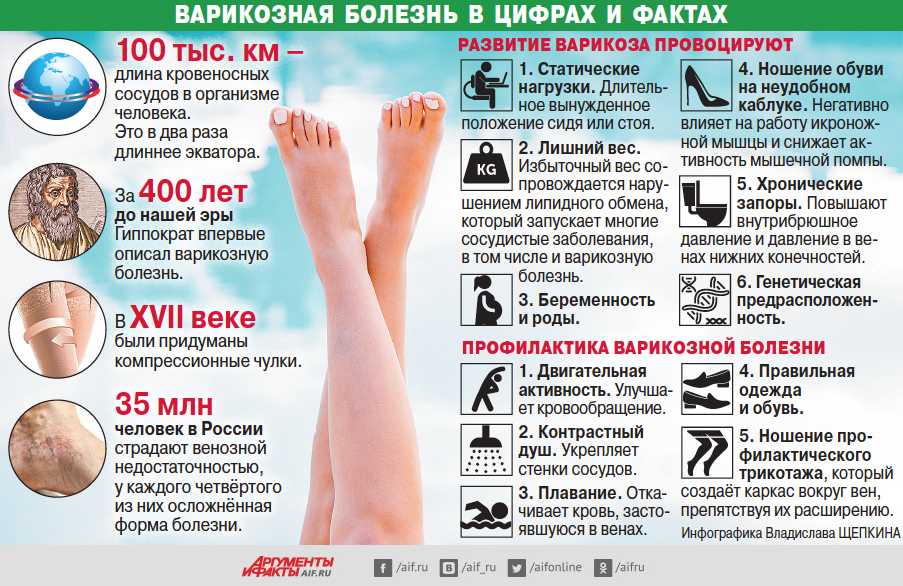 Варикозное расширение вен (варикоз) - причины, симптомы, диагностика и лечение