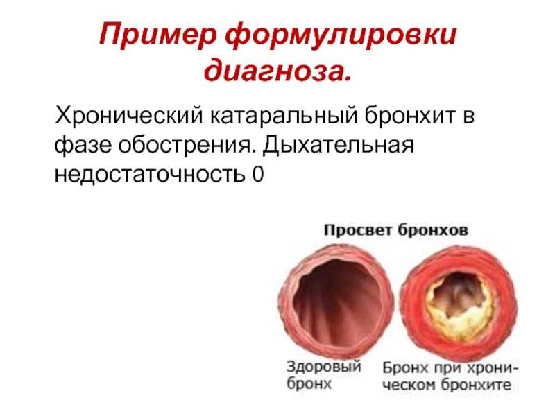 Бронхит: причины, симптомы, лечение – эл клиника