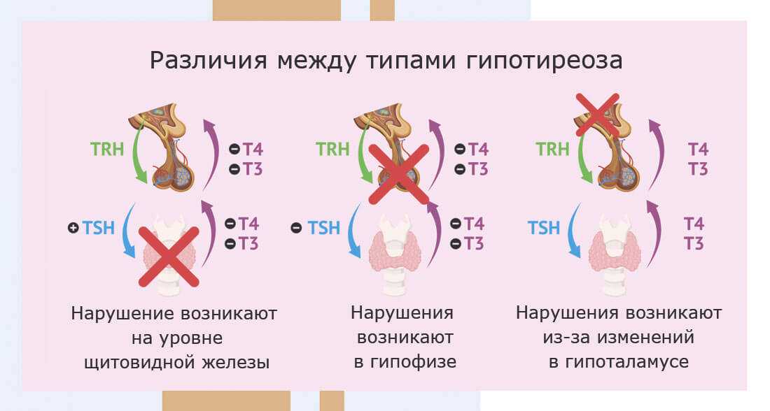 Гипотиреоз (гипофункция щитовидной железы): симптомы, лечение - напоправку – напоправку