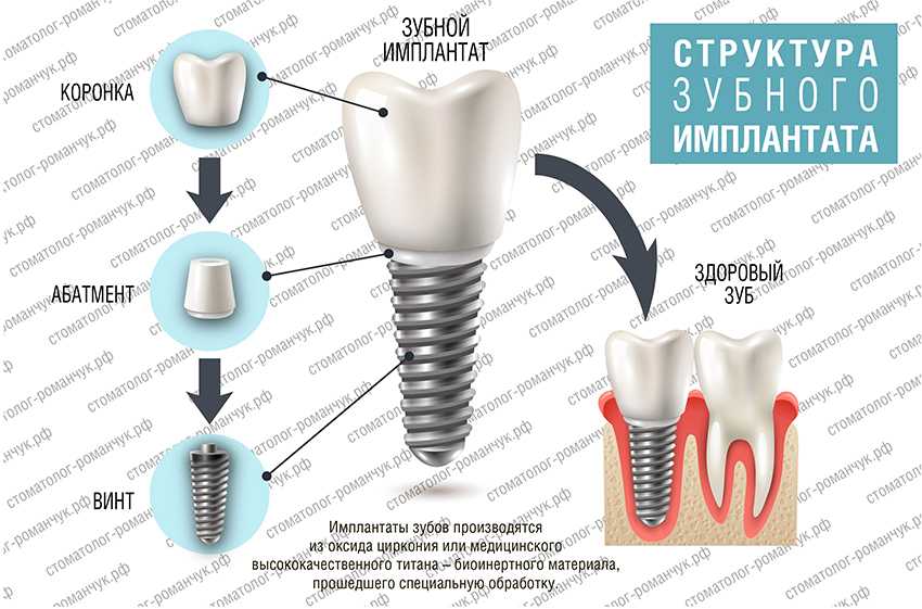 Этапы имплантации зубов схема
