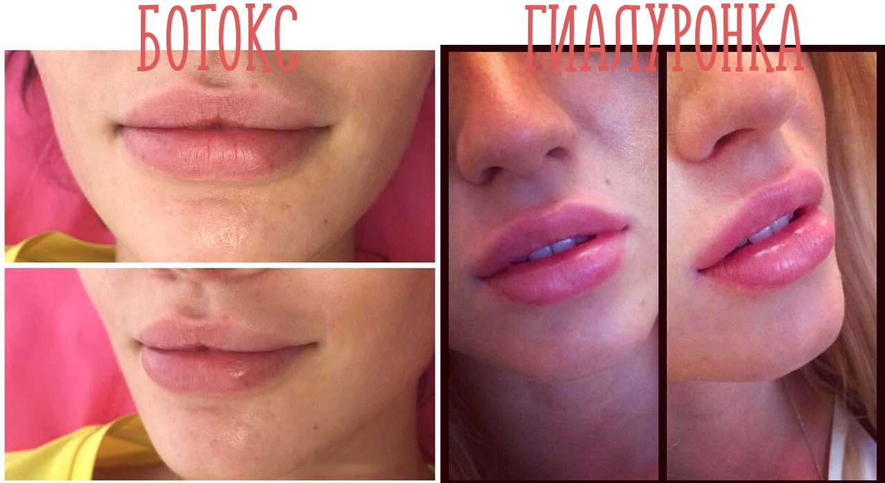 Что нельзя делать после увеличения губ гиалуроновой кислотой