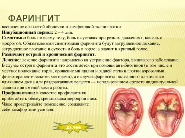 Острый тонзиллит - причины, симптомы, лечение