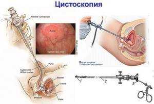 Цистоскопия (в т.ч. под наркозом)