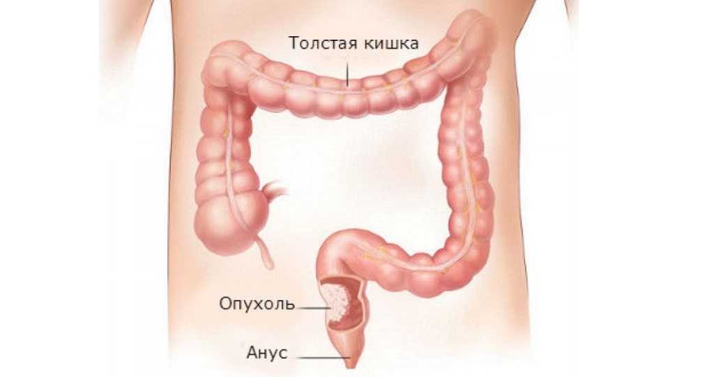 Рак прямой кишки рисунок