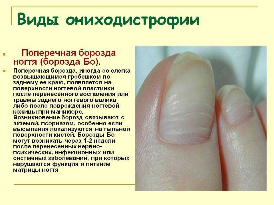 Белые полоски на ногтях: что означают, причины, лечение