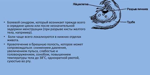 Апоплексия яичника: причины, симптомы, диагностика и лечение