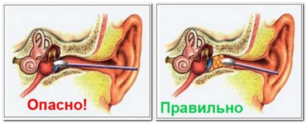 Как защитить себя от заболеваний уха и сохранить слух | evolutis clinic | дзен